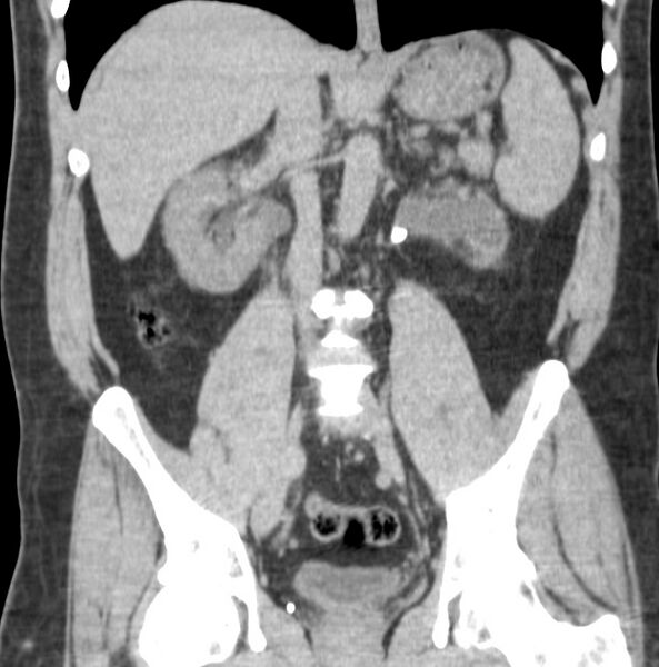 File:Atrophic kidney due to severe chronic obstructive hydronephrosis (Radiopaedia 40828-43474 Coronal non-contrast 4).jpg