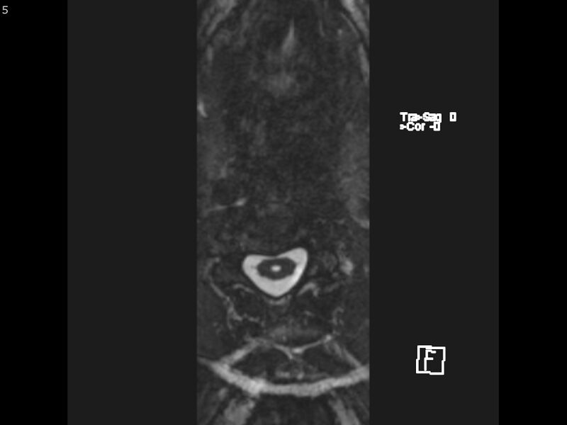 File:Atypical meningioma - intraosseous (Radiopaedia 64915-74572 Axial CISS 5).jpg