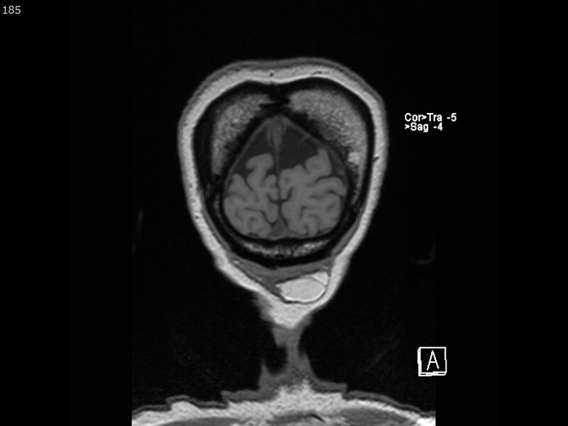 File:Atypical meningioma - intraosseous (Radiopaedia 64915-74572 Coronal T1 185).jpg