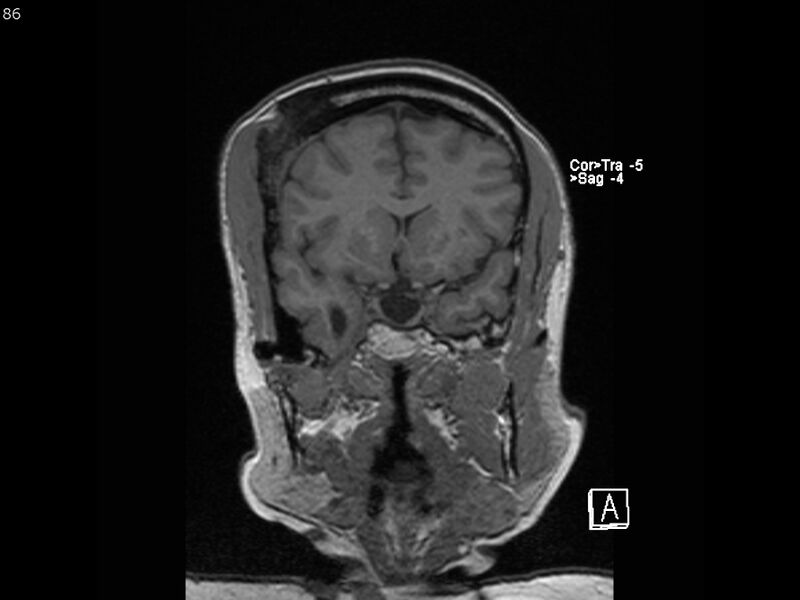 File:Atypical meningioma - intraosseous (Radiopaedia 64915-74572 Coronal T1 86).jpg