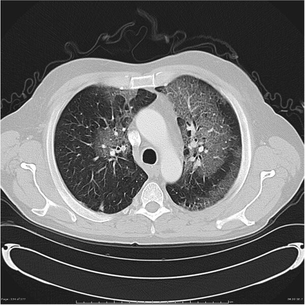 File:Atypical pneumonia - Q fever (Radiopaedia 21993-21989 lung window 13).jpg