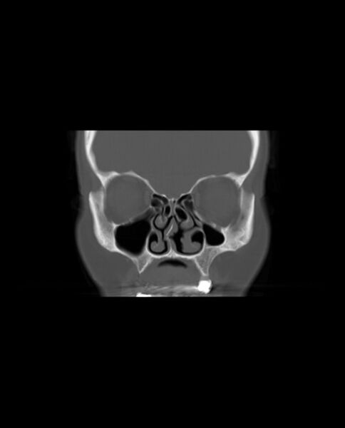 File:Automastoidectomy with labyrinthine fistula (Radiopaedia 84143-99411 Coronal non-contrast 27).jpg