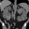 Autosomal dominant polycystic kidney disease (Radiopaedia 36539-38101 Coronal non-contrast 27).jpg