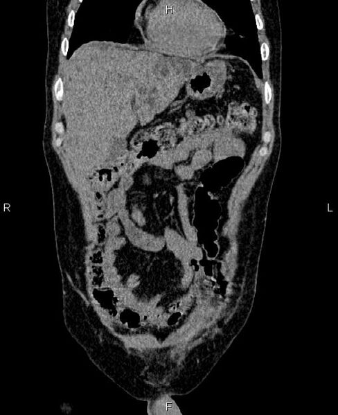 File:Autosomal dominant polycystic kidney disease (Radiopaedia 87830-104287 Coronal non-contrast 9).jpg