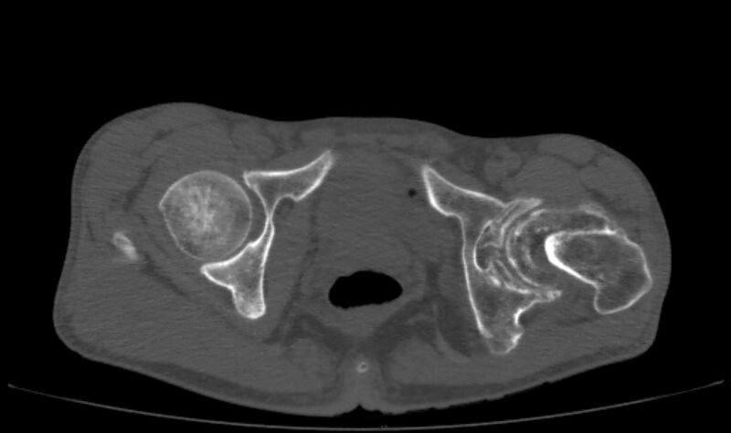 File:Avascular necrosis of the left hip (Radiopaedia 75068-86125 Axial bone window 63).jpg