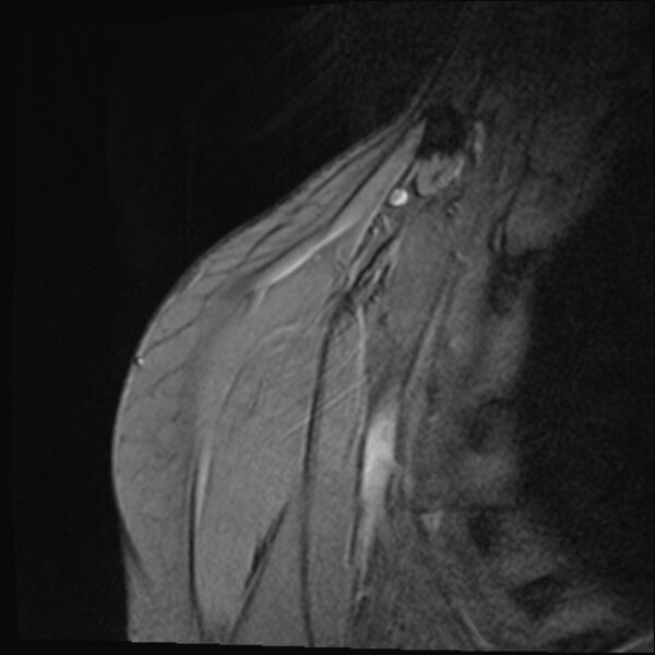 File:Avulsion fracture - greater tuberosity of humerus (Radiopaedia 71216-81515 Coronal T2 18).jpg