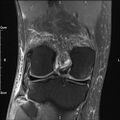 Avulsion fracture of the fibular head (Radiopaedia 74804-85808 Coronal PD fat sat 24).jpg