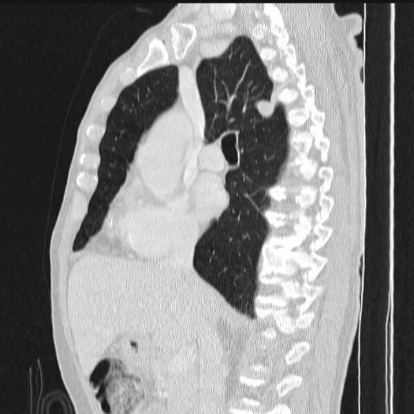 File:Azygos lobe (Radiopaedia 38259-40275 lung window 46).jpg