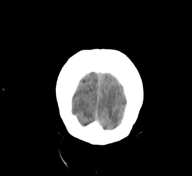 File:Basal ganglia hemorrhage (Radiopaedia 58759-65981 Coronal non-contrast 12).jpg