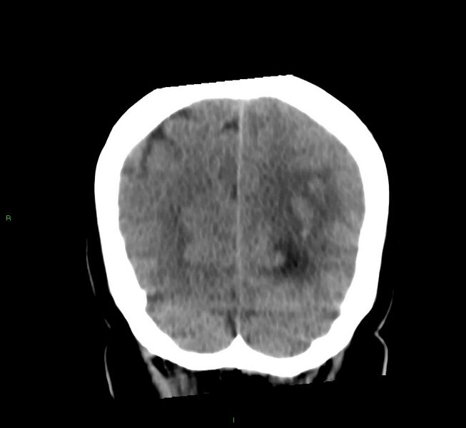 File:Basal ganglia hemorrhage (Radiopaedia 58759-65981 Coronal non-contrast 21).jpg