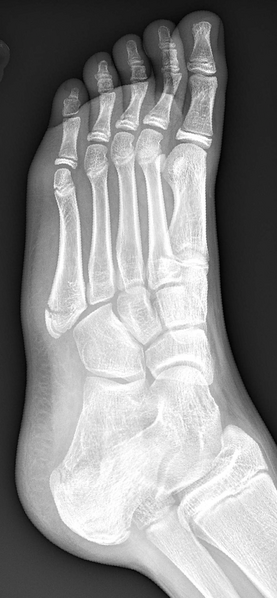File:Base of 5th metatarsal apophysis and fracture (Radiopaedia 30847-31560 Oblique 1).png