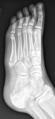 Base of 5th metatarsal apophysis and fracture (Radiopaedia 30847-31560 Oblique 1).png
