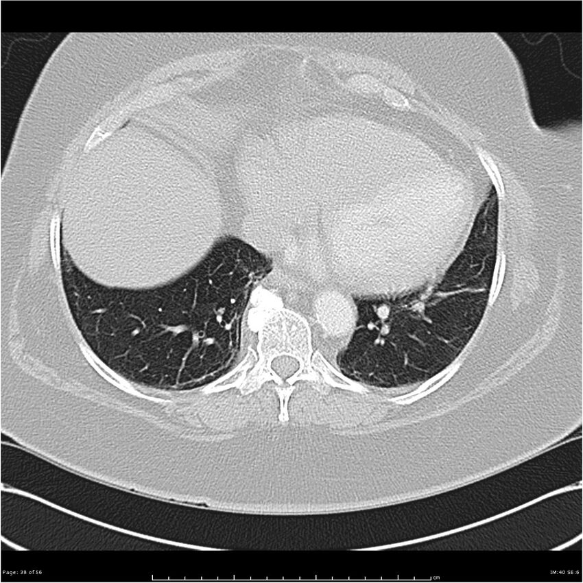 Benign metastasizing leiomyoma (Radiopaedia 26803-26962 Axial lung window 38).jpg