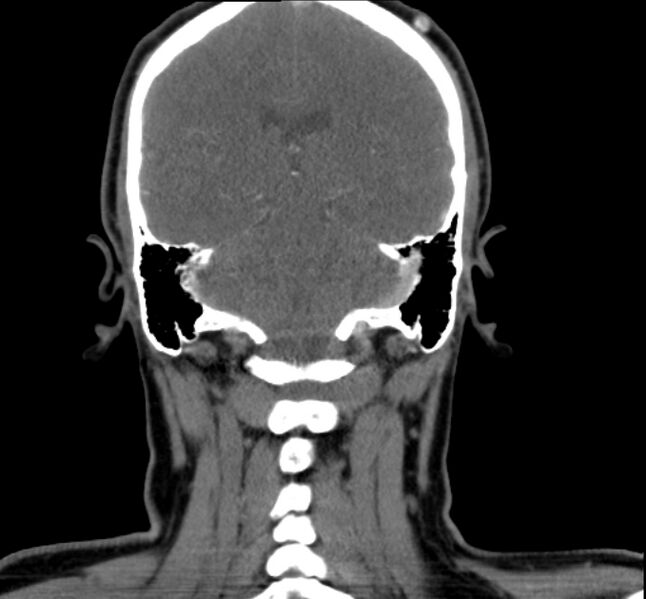 File:Benign mixed salivary tumor of the parotid gland (Radiopaedia 35261-36792 B 25).jpg