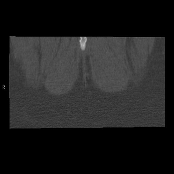 File:Bertolotti syndrome (Radiopaedia 24864-25128 Coronal bone window 60).jpg