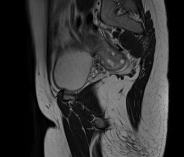 File:Bicornuate uterus (Radiopaedia 71214-81511 Sagittal T2 24).jpg