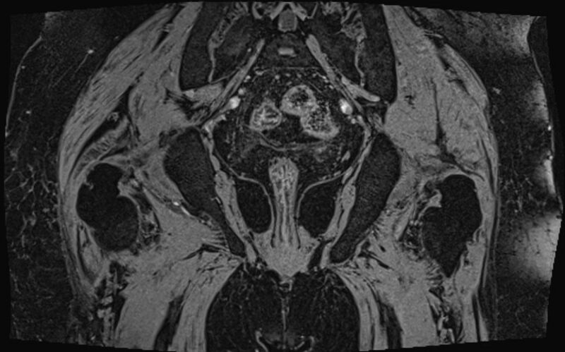 File:Bilateral avascular necrosis of femoral head (Radiopaedia 77116-89078 Coronal T2 we 1).jpg