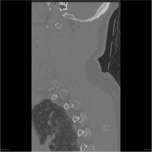 File:Bilateral cervical ribs (Radiopaedia 25868-26017 Sagittal bone window 58).jpg