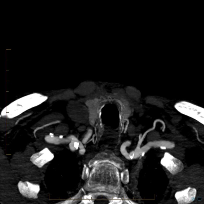 Bilateral chronic common carotid occlusion (Radiopaedia 50849-56362 D 51).jpg