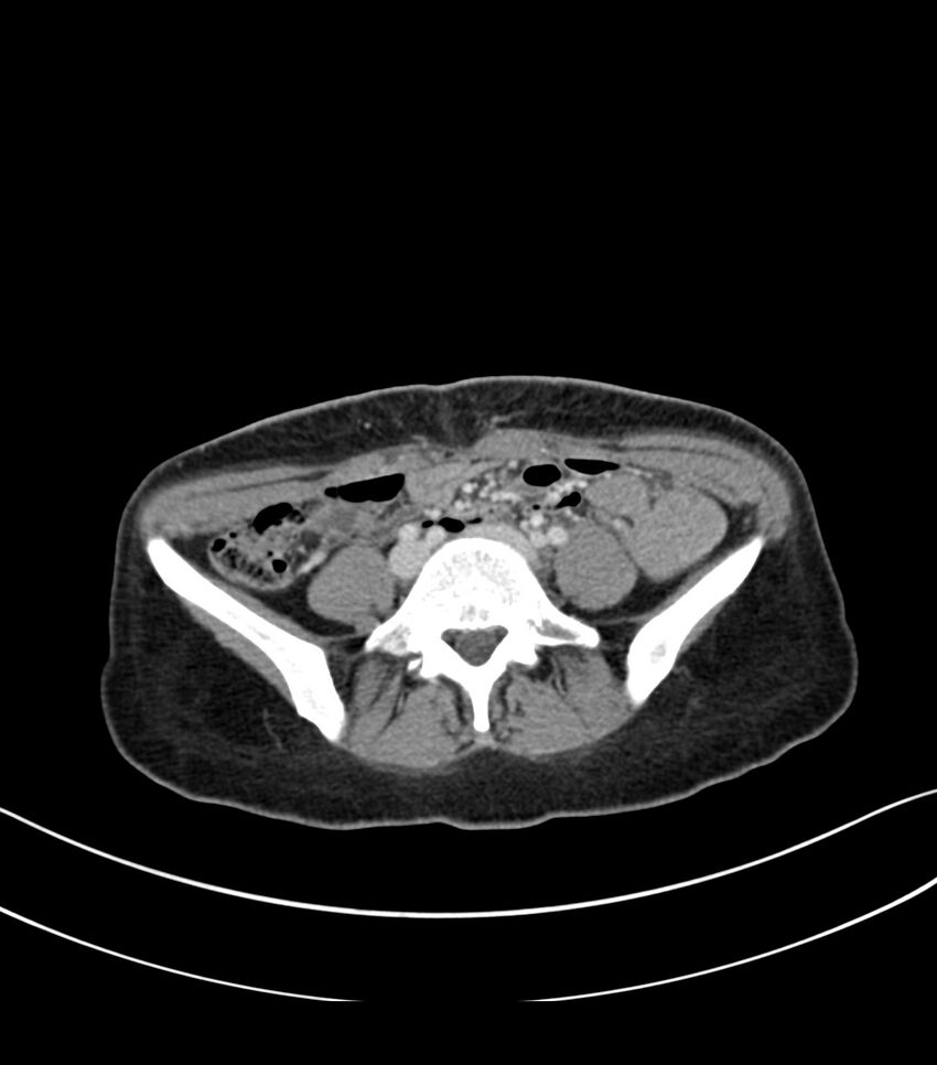 Bilateral kidney malrotation (Radiopaedia 72227-82749 A 48).jpg