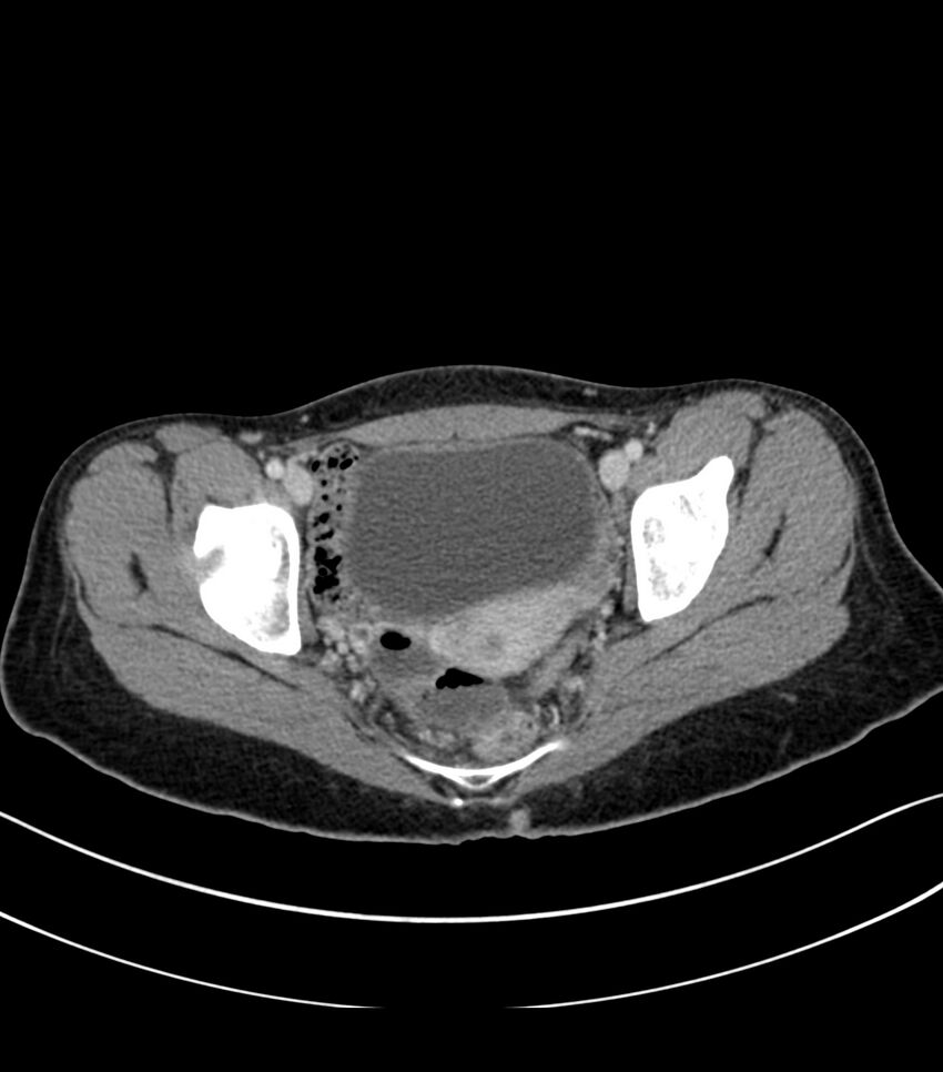 Bilateral kidney malrotation (Radiopaedia 72227-82749 A 61).jpg