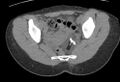 Bilateral mature cystic ovarian teratoma (Radiopaedia 88821-105592 Axial non-contrast 22).jpg