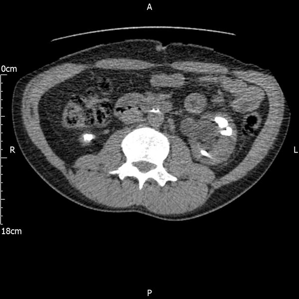 File:Bilateral medullary nephrocalcinosis with ureteric calculi (Radiopaedia 71269-81569 Axial non-contrast 54).jpg