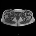 Bilateral ovarian fibroma (Radiopaedia 44568-48293 Axial T1 27).jpg