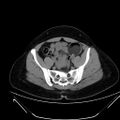 Bilateral ovarian mature cystic teratomas (Radiopaedia 79373-92457 Axial non-contrast 54).jpg