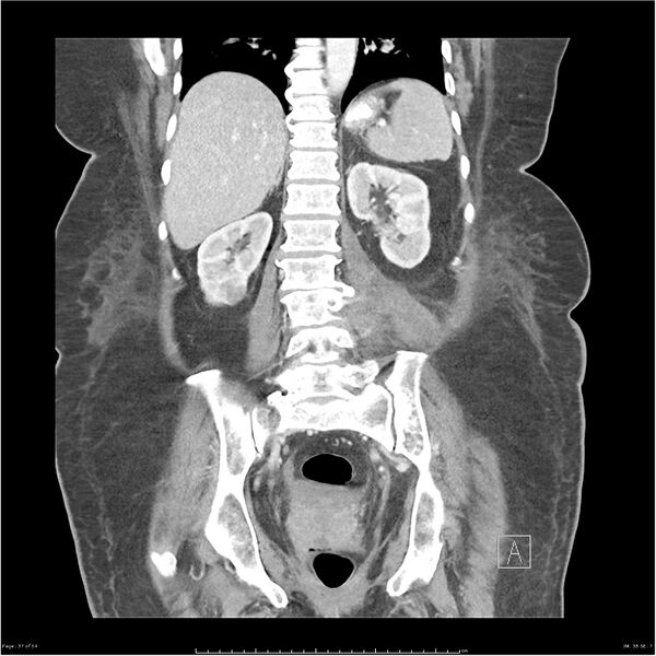 File:Bilateral psoas hematomas (Radiopaedia 24057-24279 B 37).jpg