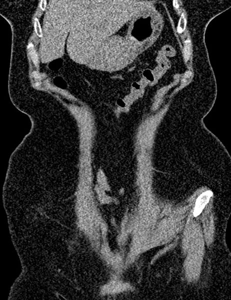 File:Bilateral staghorn calculi (Radiopaedia 59475-66842 Coronal non-contrast 40).jpg