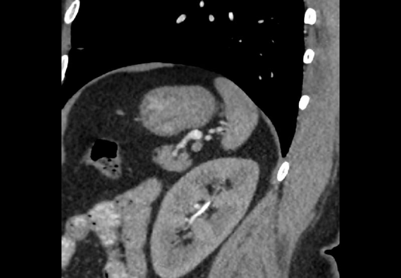 File:Bilateral urolithiasis with incidentally detected splenic artery aneurysm and left inferior vena cava (Radiopaedia 44467-48127 Ob. Sag. C+ Art. 4).jpg