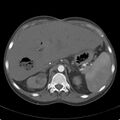 Biliary necrosis - liver transplant (Radiopaedia 21876-21846 A 20).jpg