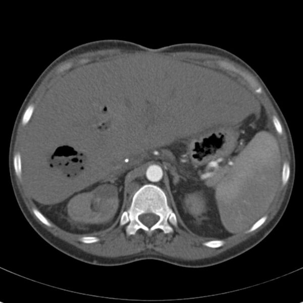 File:Biliary necrosis - liver transplant (Radiopaedia 21876-21846 A 20).jpg
