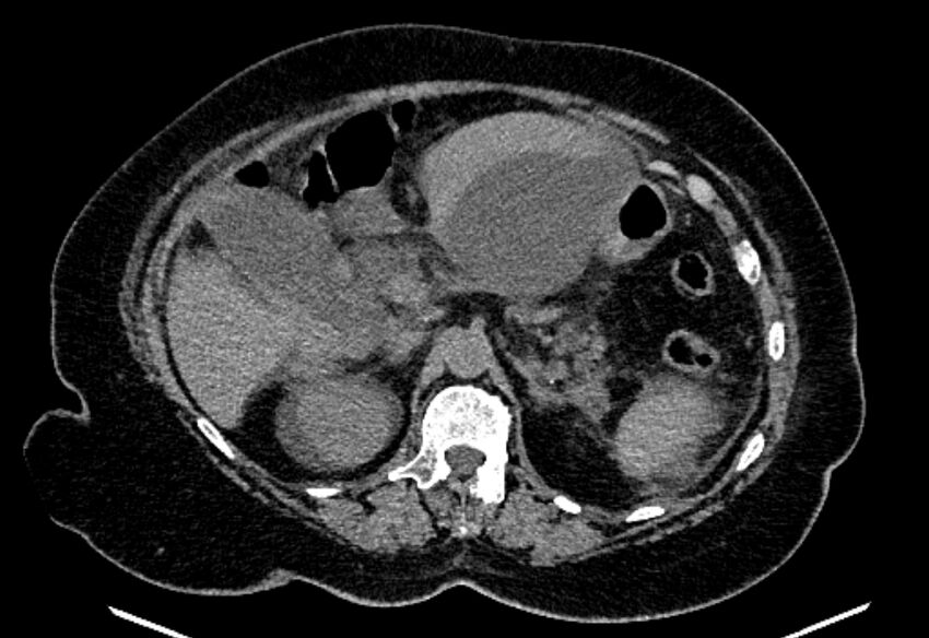 Biliary pancreatitis (Radiopaedia 72289-82823 Axial non-contrast 92).jpg