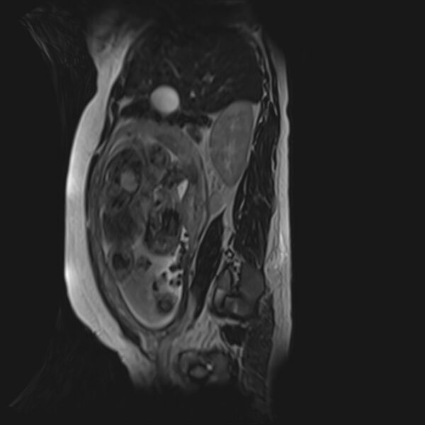 File:Bilobed placenta accreta (Radiopaedia 69648-79591 G 42).jpg