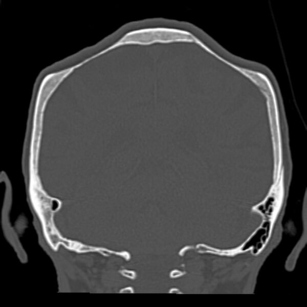 File:Biparietal osteodystrophy (Radiopaedia 46109-50463 Coronal bone window 74).jpg