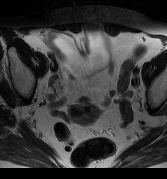 File:Bladder tumor detected on trauma CT (Radiopaedia 51809-57639 Axial T2 2).jpg
