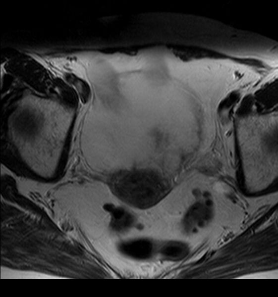 File:Bladder tumor detected on trauma CT (Radiopaedia 51809-57639 Axial T2 5).jpg