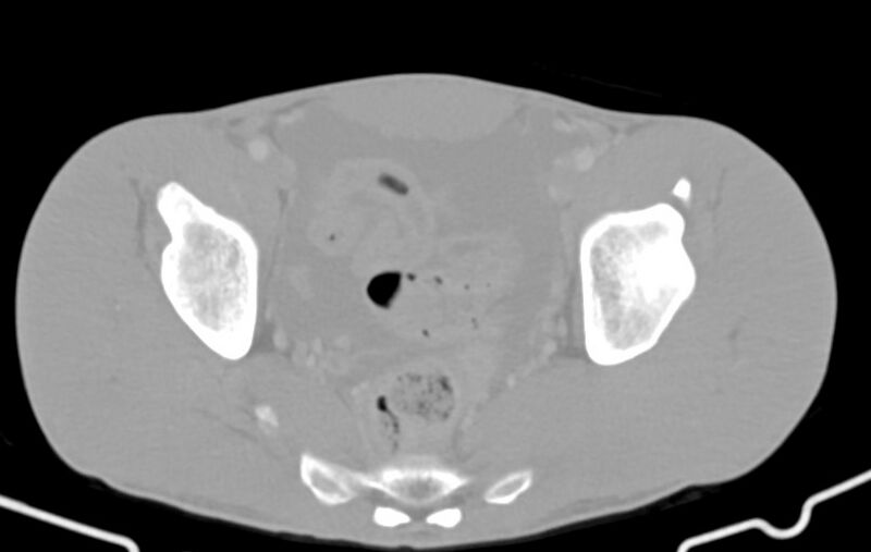 File:Blunt injury to the small bowel (Radiopaedia 74953-85987 Axial Wide 85).jpg