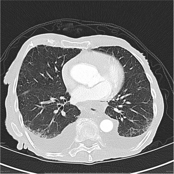 File:Boerhaave syndrome (Radiopaedia 26240-26362 Axial lung window 30).jpg
