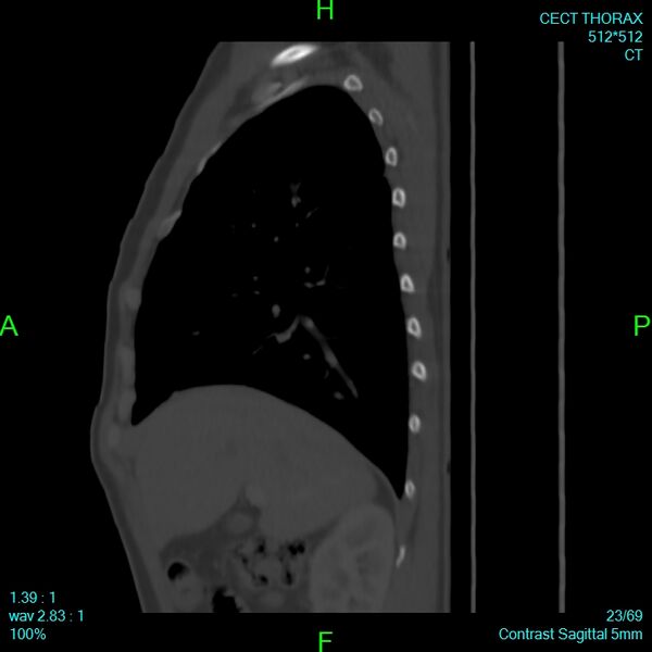 File:Bone metastases from lung carcinoma (Radiopaedia 54703-60937 Sagittal bone window 23).jpg
