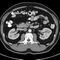 Bosniak cyst - type IV (Radiopaedia 23525-23627 renal cortical phase 26).jpg