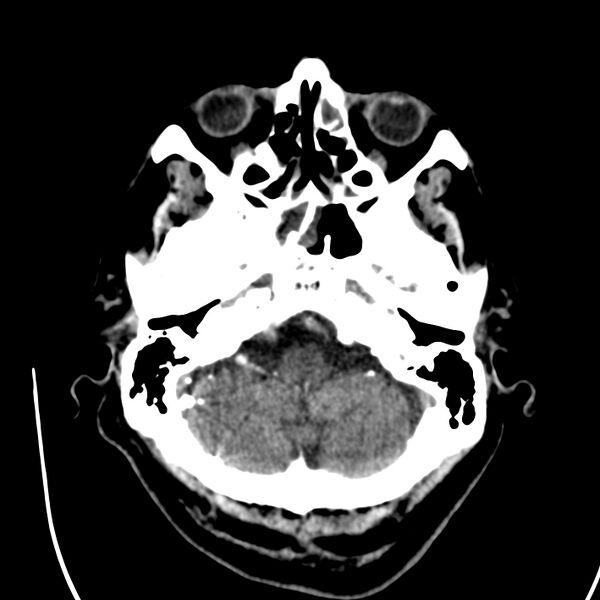 File:Brain Pantopaque remnants (Radiopaedia 78403-91048 Axial non-contrast 26).jpg