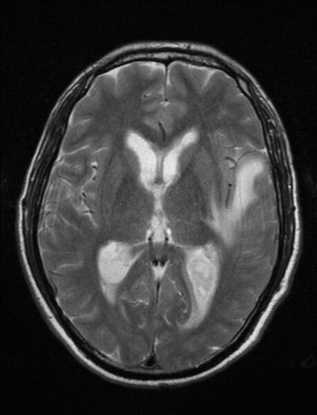 File:Brain abscess with ventriculitis (Radiopaedia 85703-101495 Axial T2 14).jpg