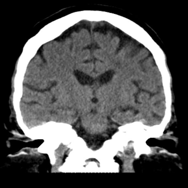 File:Brain cortical laminar necrosis (Radiopaedia 25822-25971 C 30).jpg