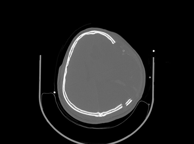 File:Brain injury by firearm projectile (Radiopaedia 82068-96087 A 129).jpg
