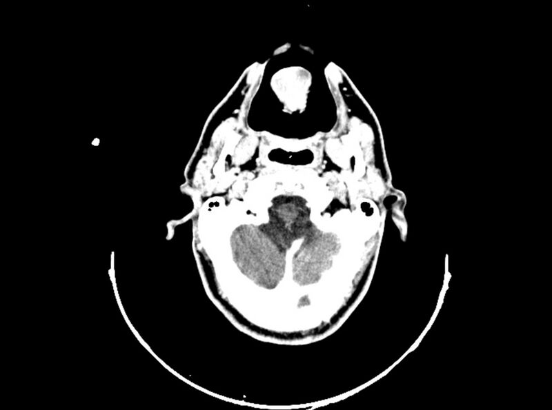 File:Brain injury by firearm projectile (Radiopaedia 82068-96088 B 63).jpg