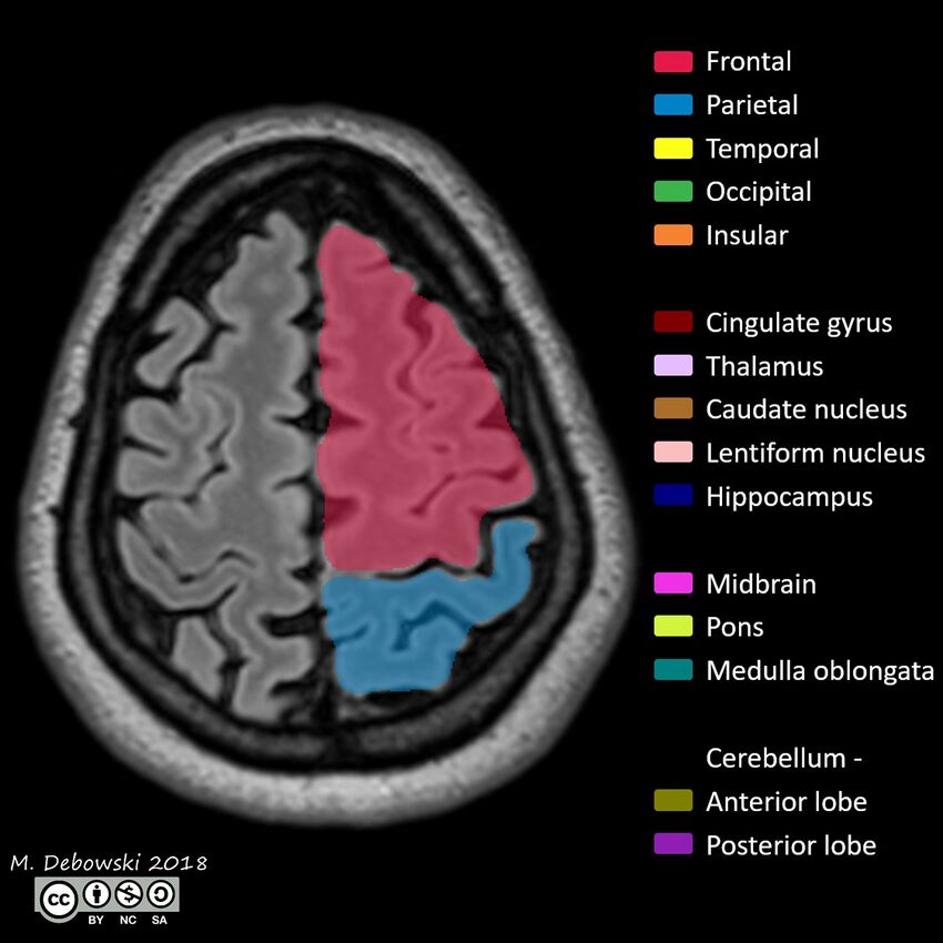 Brain lobes - annotated MRI (Radiopaedia 61691-69700 Axial 10).JPG