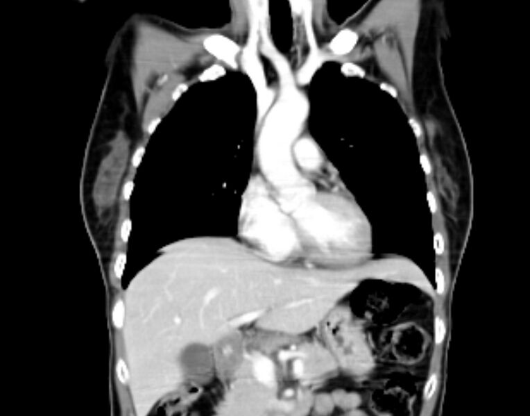 File:Brain metastasis as initial presentation of non-small cell lung cancer (Radiopaedia 65122-74127 C 11).jpg